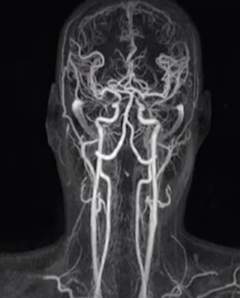 МР-ангиография артерий головы и шеи
