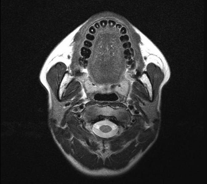 Киста слюнной железы на МРТ полости рта 