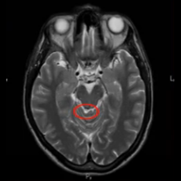 Очаги в головном мозге на МРТ