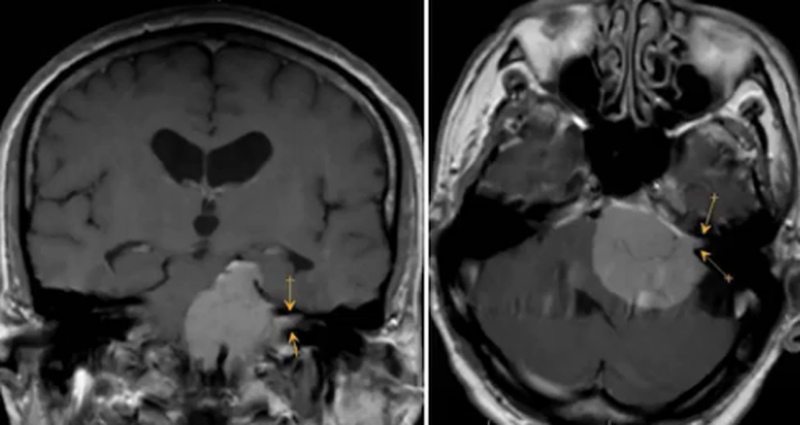 МР-изображение невриномы
