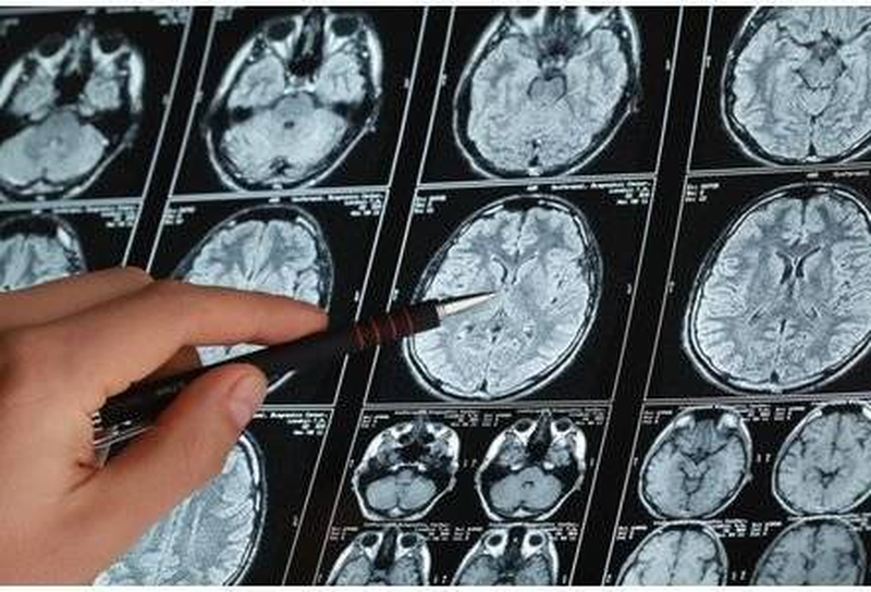 Снимки головного мозга на МРТ