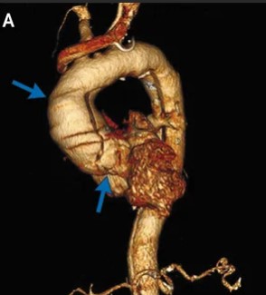  Рисунок: анатомия главной артерии организма в норме