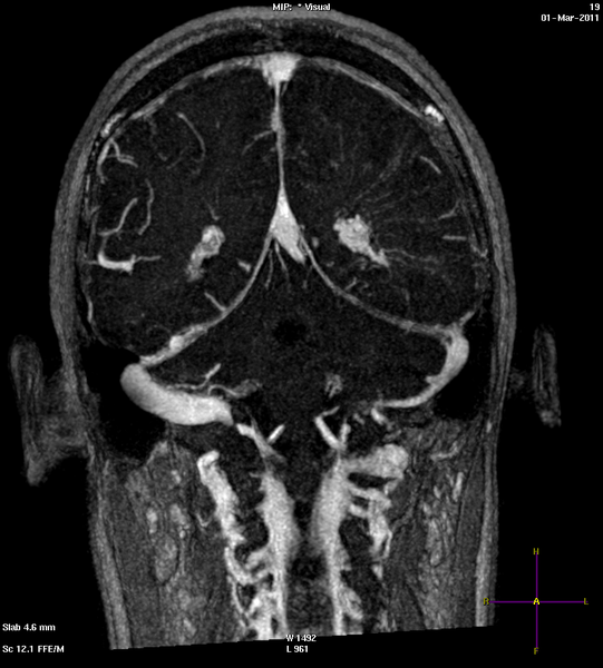 Тромбоз сосудов головного мозга на МРТ