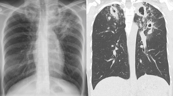 Рентгенограмма (слева) и компьютерная томограмма (справа): туберкулезное поражение верхних долей с обеих сторон