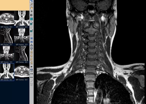 Магнитно-резонансное сканирование шейного отдела позвоночника