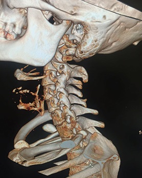 Деформирующий спондилез (образование костных наростов) в шейном отделе позвоночника