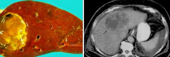 Воспалительно-некротический внутриорганный очаг в печени: макропрепарат и КТ-изображение