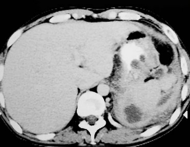 Основной рентгеносемиотический симптом гнойника на компьютерных томограммах
