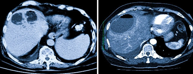 Абсцесс печени на КТ