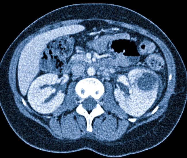 Пример скана, выполненного КТ-аппаратом: гнойник в левой почке