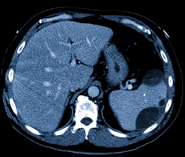Абсцесс селезенки на КТ