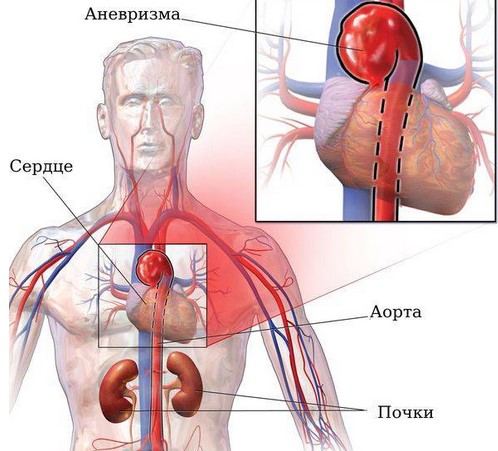 На изображении схематично показана аневризма грудной части аорты в области дуги