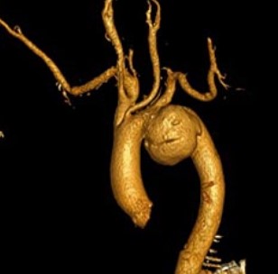 3D-реконструкция аневризмы аортальной дуги