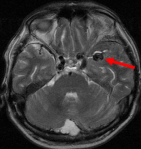 Аневризматическое расширение левой средней мозговой артерии на МР-снимке
