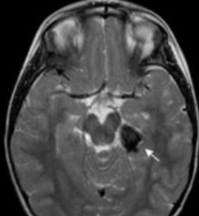 Аневризма головного мозга на МРТ