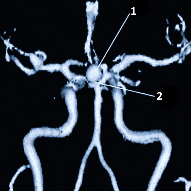 Аневризма головного мозга на МРТ