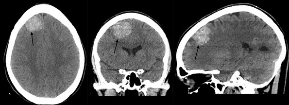 КТ головного мозга: кавернома лобно-теменной области справа 