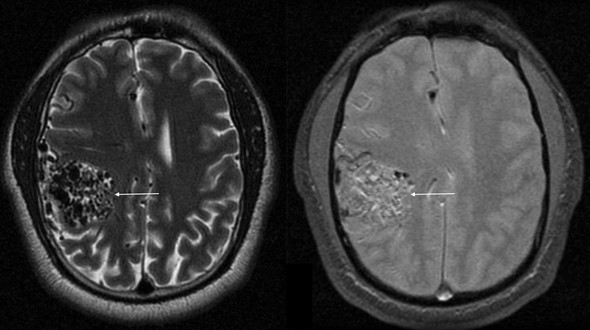МР-томограммы, отражающие артерио-венозную ангиому правой гемисферы мозга 