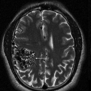 Ангиома головного мозга на КТ