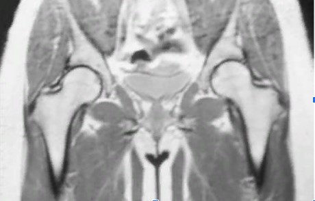 Магнитно-резонансная томография тазобедренных суставов