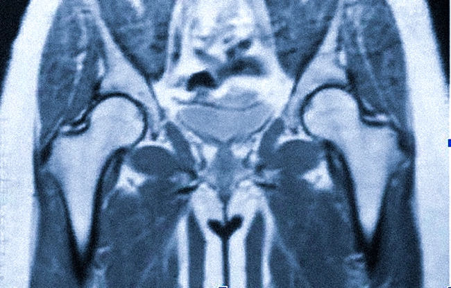 Магнитно-резонансная томография тазобедренных суставов