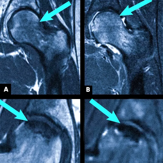Асептический некроз головки бедренной кости на МРТ