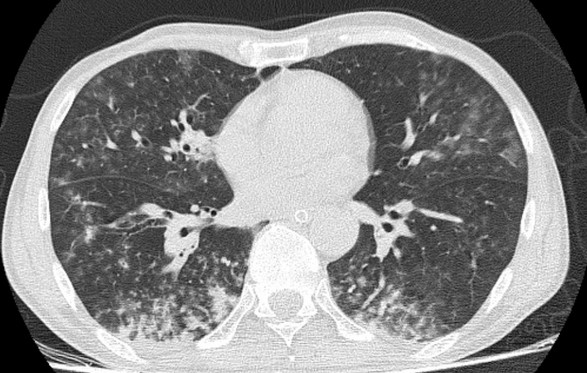 Снимок пациента, находящегося на искусственной вентиляции легких (в нижних долях признаки воспаления)