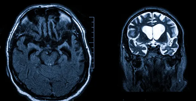 Атрофия лобных и височных долей на МР-сканах