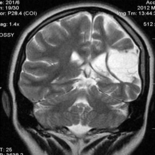Атрофия головного мозга на МРТ