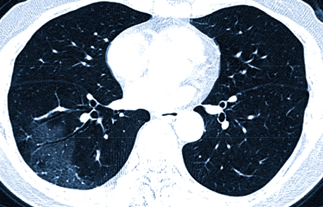 Воспаление легких на КТ