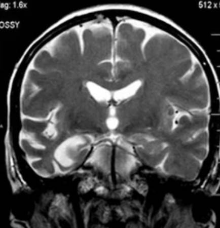 Изменения головного мозга на МРТ при болезни Альцгеймера