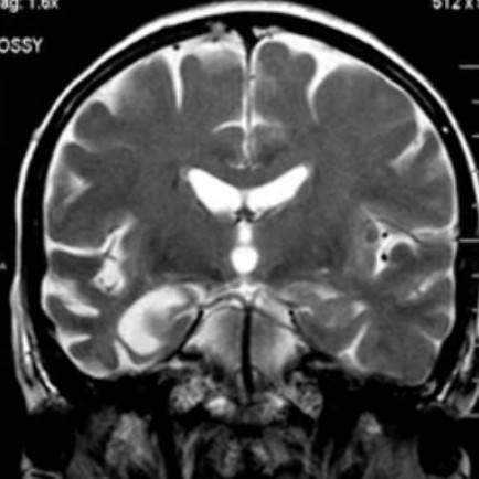 Болезнь Альцгеймера на МРТ
