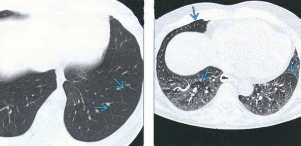  Патологические изменения легочной ткани (стрелки) при анкилозирующем спондилоартрите