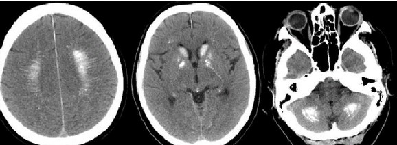 Болезнь Фара КТ-томограмме: симметричные двусторонние петрификаты в веществе головного мозга