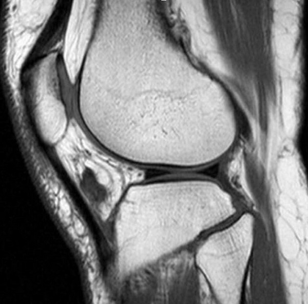 МР-снимки коленного сустава при болезни Гоффа