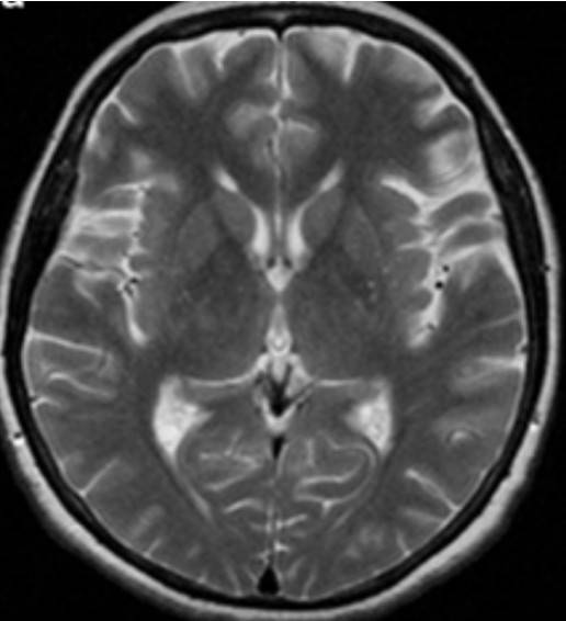 МР-томограмма пациента с дрожательным параличом