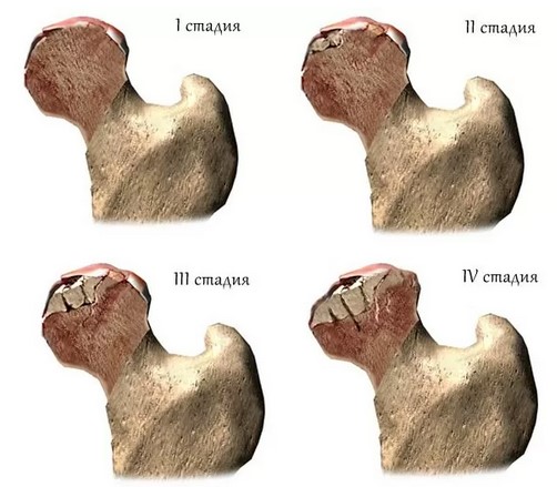 Изменение головки бедренной кости при прогрессировании болезни Пертеса