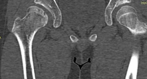 КТ-изображение: асептический некроз головки бедренной кости справа