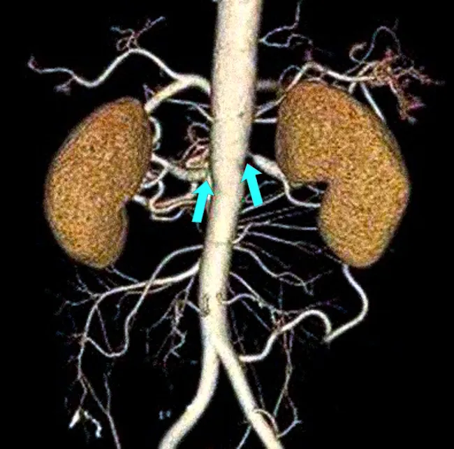 Стрелками обозначены участки сужения почечных артерий, выявленные на КТ