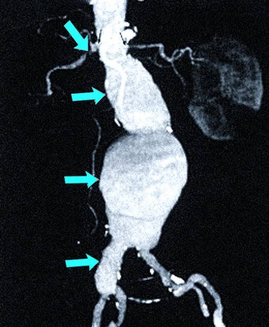 Аневризматические расширения брюшной аорты обозначены стрелками