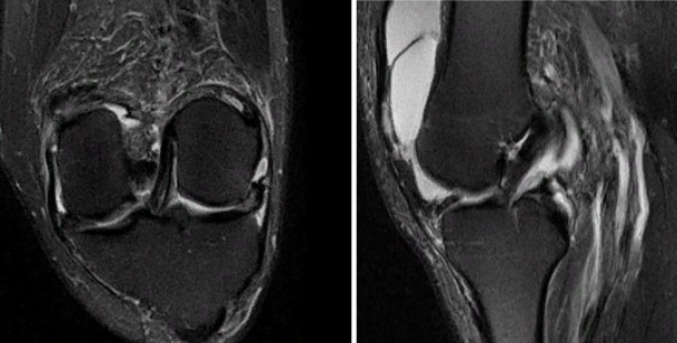 Нормальная анатомия коленного сустава на МРТ