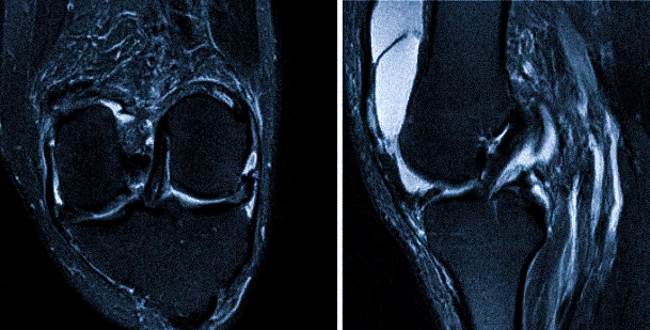 Нормальная анатомия коленного сустава на МРТ