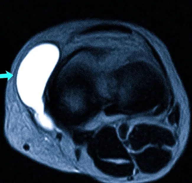Бурсит коленного сустава на МРТ
