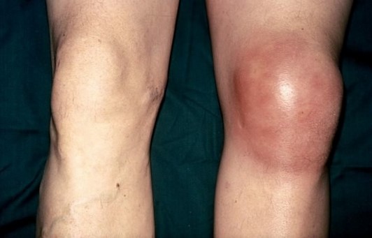 Вид нижней конечности при воспалении синовиальной сумки колена