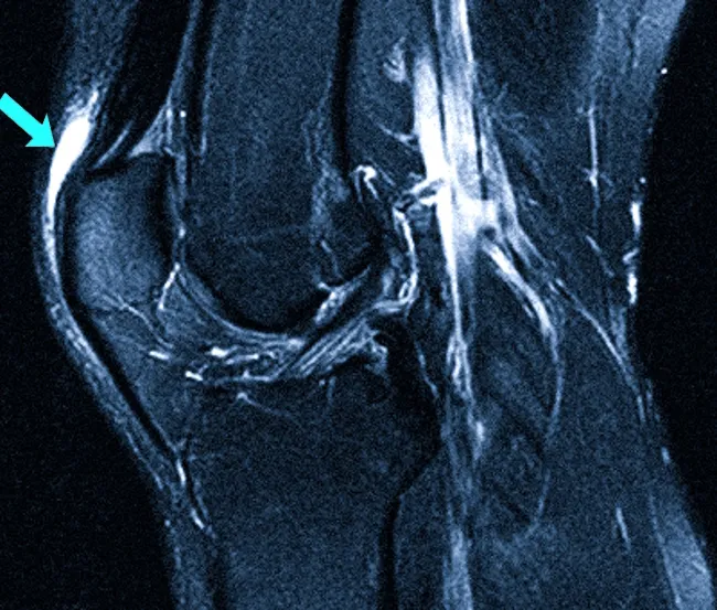 Воспаление передней подкожной преднадколенниковой сумки на МРТ