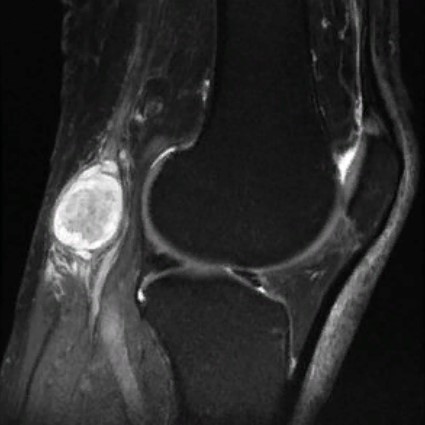 Бурсит коленного сустава на МРТ