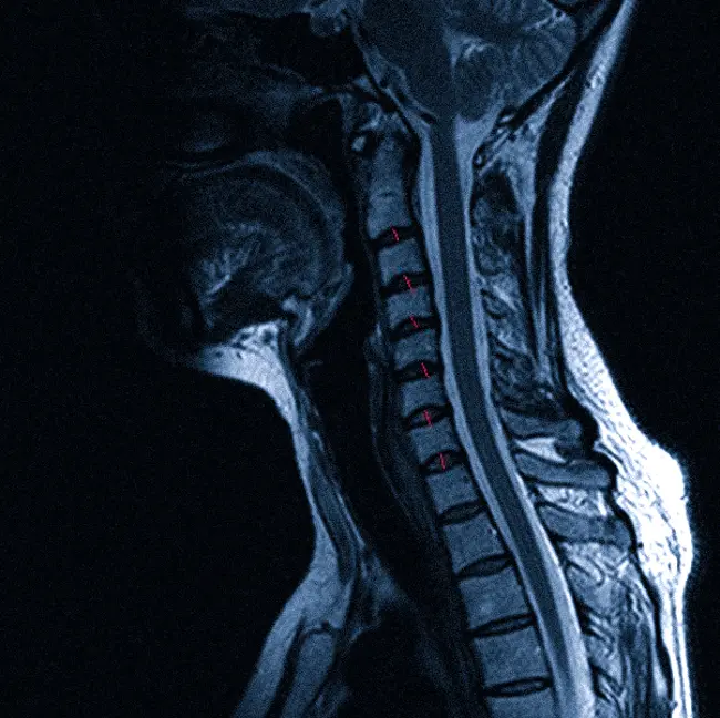 МРТ шейного отдела позвоночника