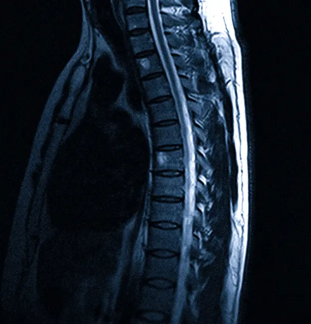гемангиомы на МРТ грудного отдела позвоночника