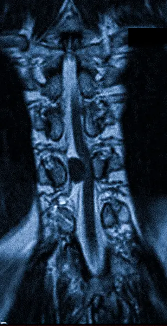 Опухоль на МРТ шейного отдела позвоночника