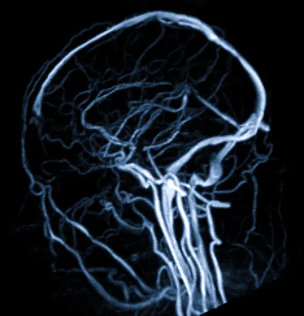 МРТ сосудов головы